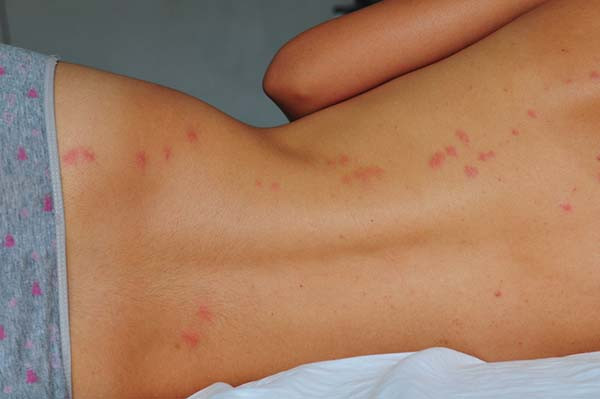 Identifying a Bed Bug Infestation