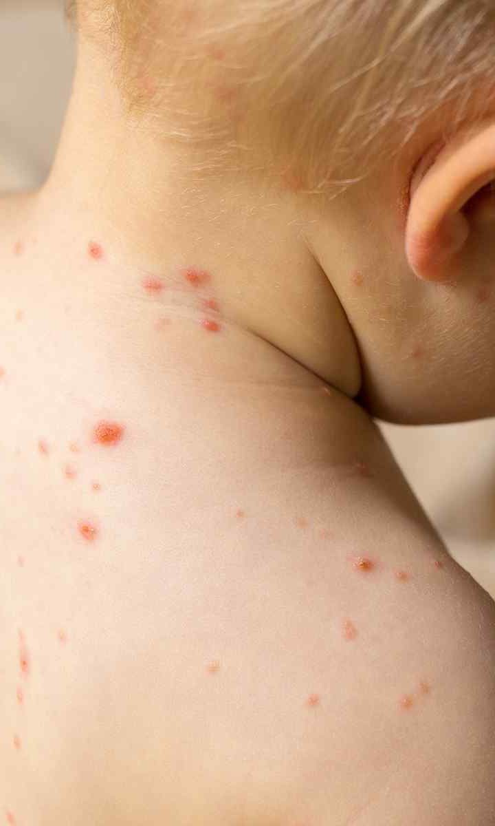 Everything You Need to Know About Measles Everything You Need to Know About Measles